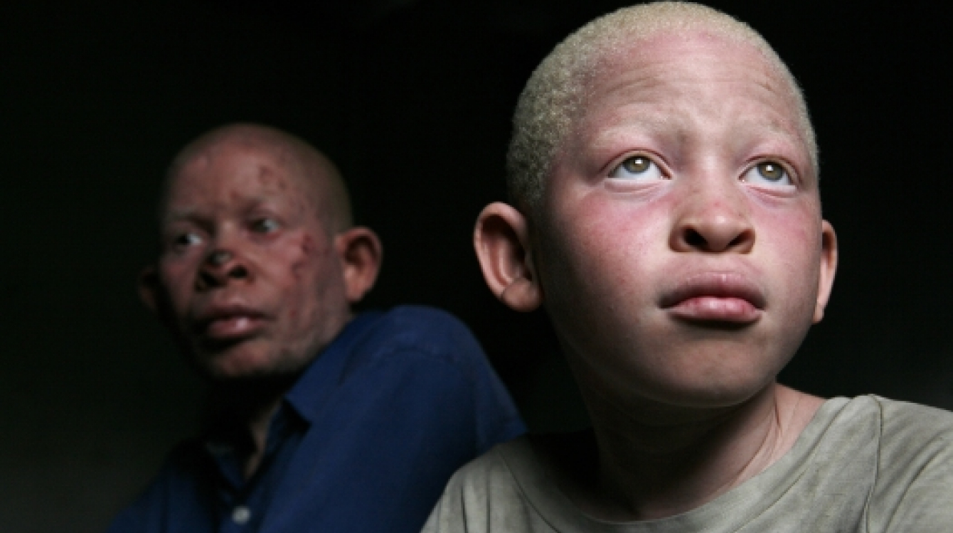 Únase al Día Internacional de Sensibilización sobre el Albinismo 1
