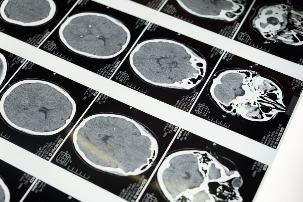 ¿Cómo identificar un ACV? La regla CORRE+ puede salvar vidas